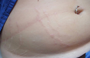 carboxy-stretch-mark-therapy-nyc